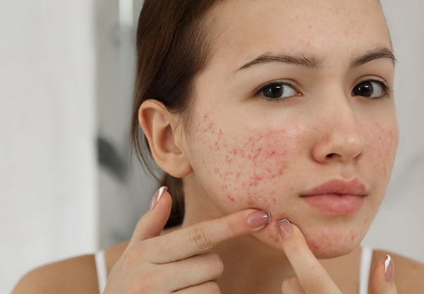 da chăm kỹ vẫn không hết mụn ở người trưởng thành